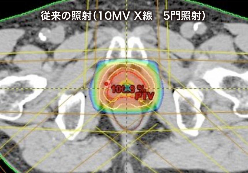従来の照射（10MV X線　5門照射）