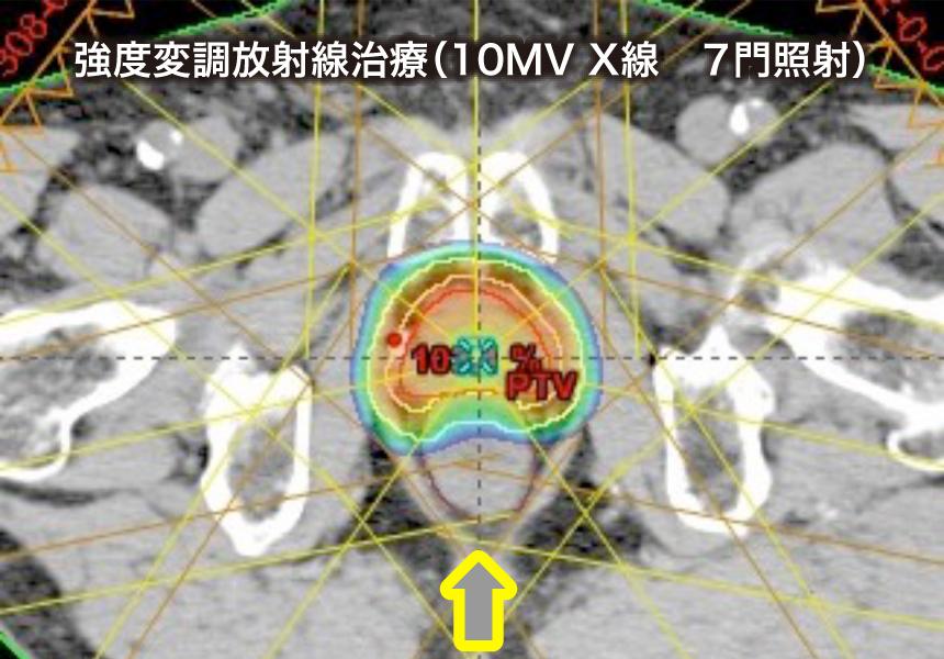 強度変調放射線治療（10MV X線　７門照射）