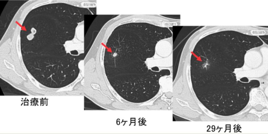 転移性肺腫瘍に対して定位放射線治療を行った症例