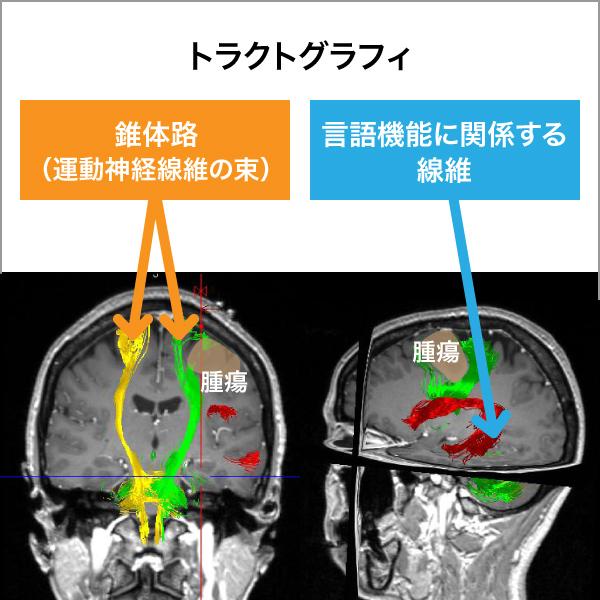 図2a　トラクトグラフィ