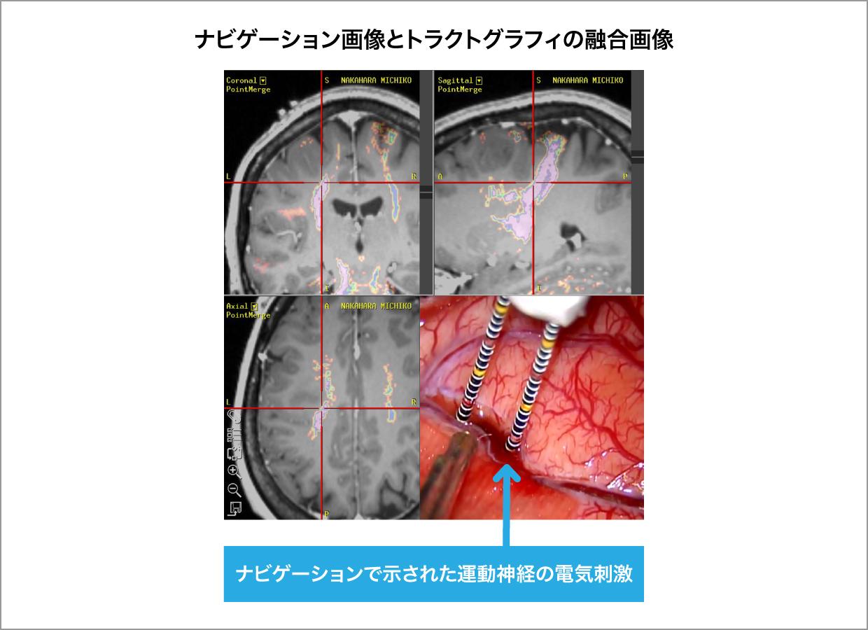 ナビゲーション画像とトラクトグラフィの融合画像