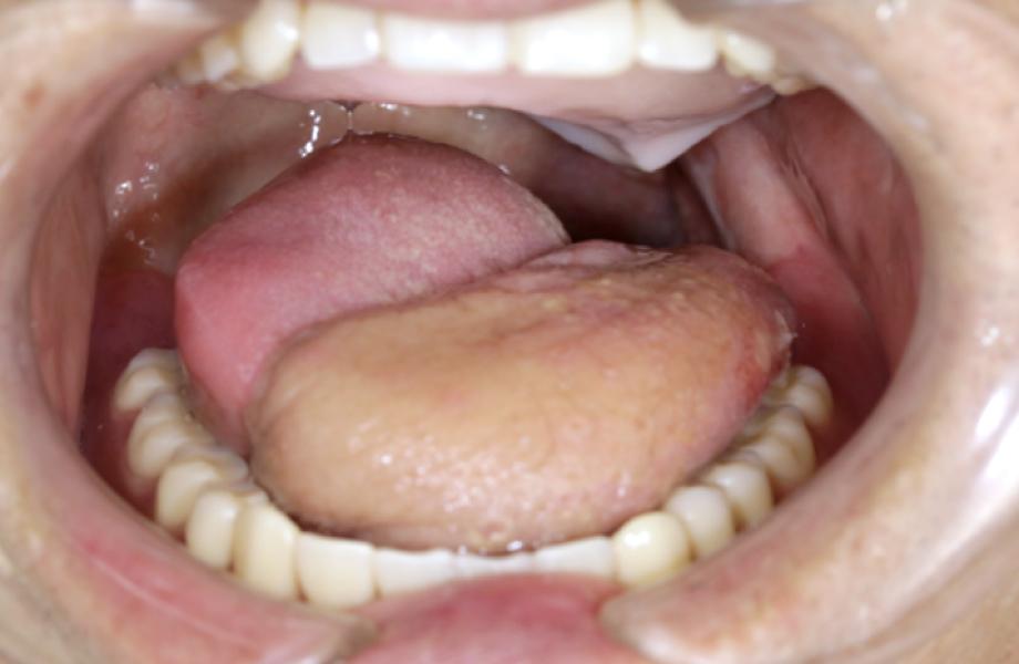 左舌がん術後（舌接触補助床を装着）