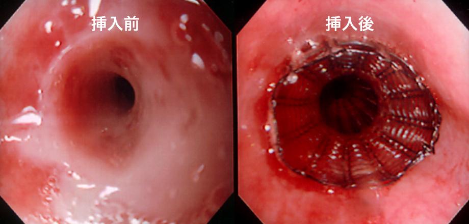 食道ステント