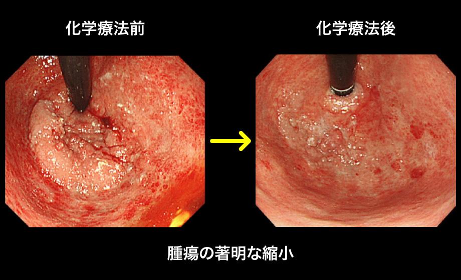 腹膜播種胃癌