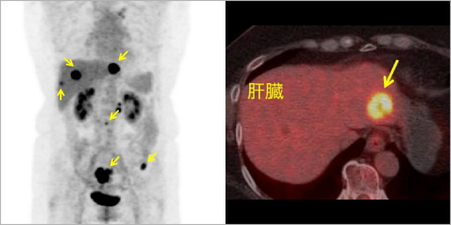 図6　PET検査
