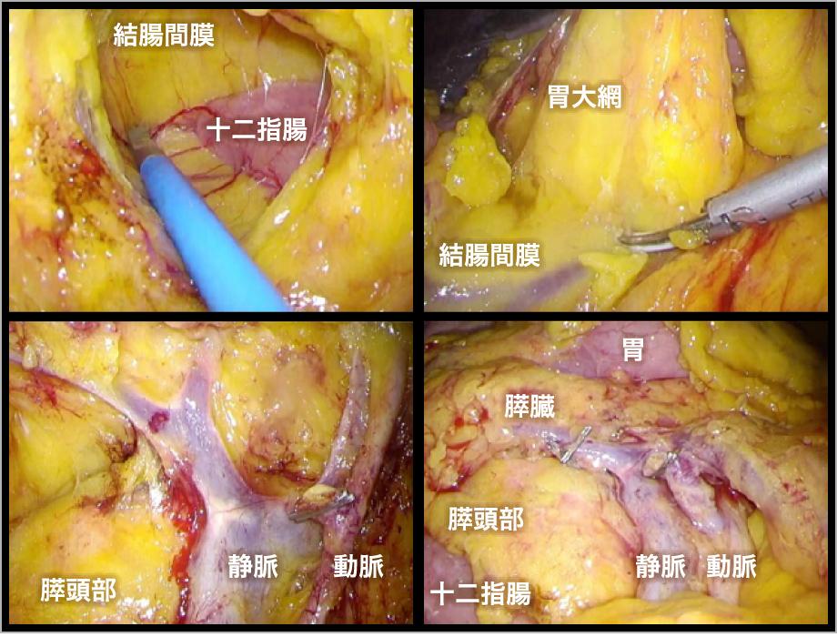 図8　腹腔内の内視鏡像