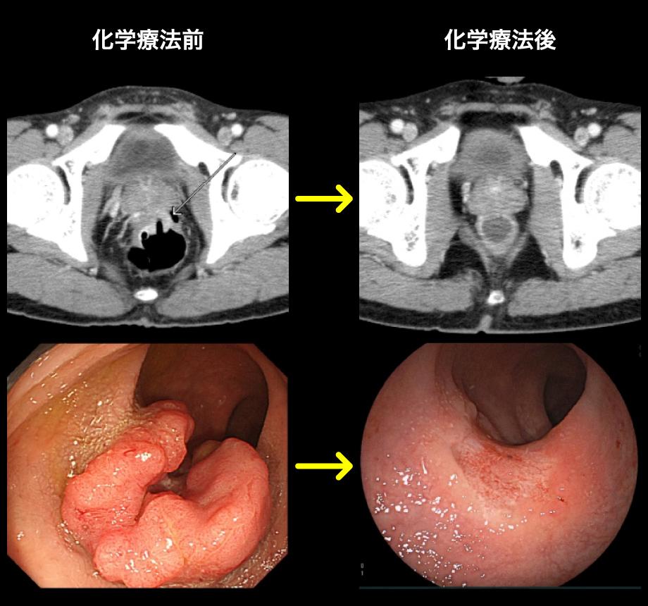 化学療法前と後