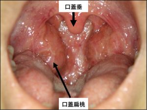 咽頭疾患