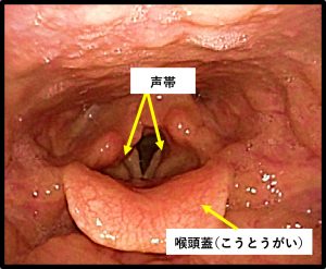 喉頭疾患