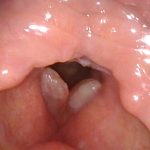 ポリープ様声帯 または 浮腫性声帯炎