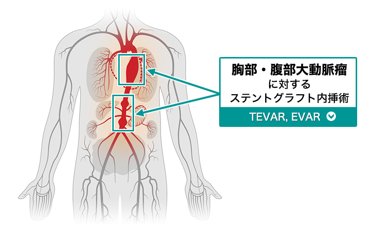 胸部・腹部大動脈瘤に対するステントグラフト内挿術（TEVAR/EVAR）