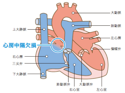 心房中隔欠損症