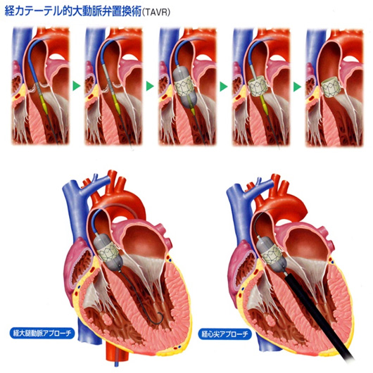 経カテーテル的大動脈弁置換術