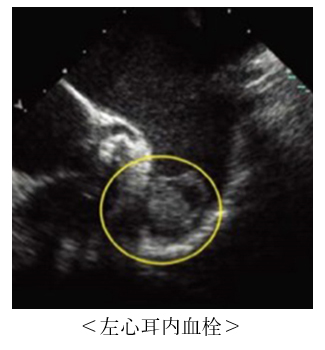 左心耳内血栓