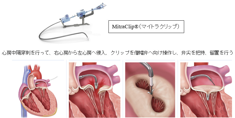 MitraClip®（マイトラクリップ）、心房中隔穿刺を行って、右心房から左心房へ侵入、クリップを僧帽弁へ向け操作し、弁尖を把持、留置を行う