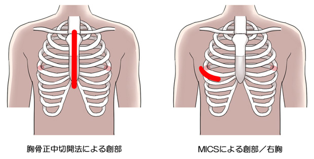 小切開心臓手術、ポートアクセス手術