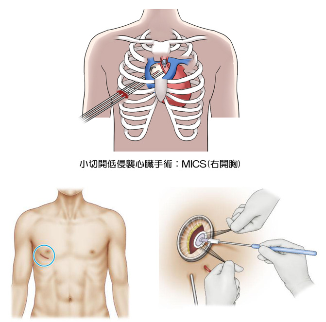 小切開の心臓手術
