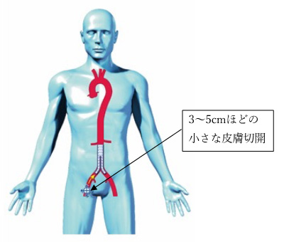 3〜5㎝ほどの小さな皮膚切開