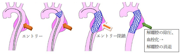 ステントグラフト治療